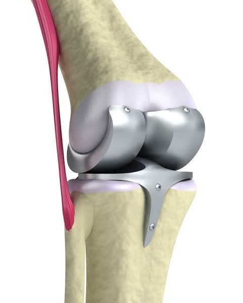 Partial Robotic Knee Replacement in Mumbai